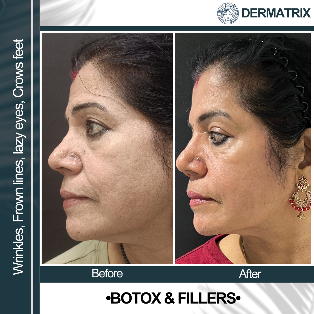 Botox_-_fillers_3