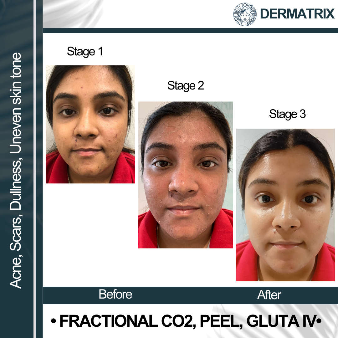 Co2__peel__gluta_iv