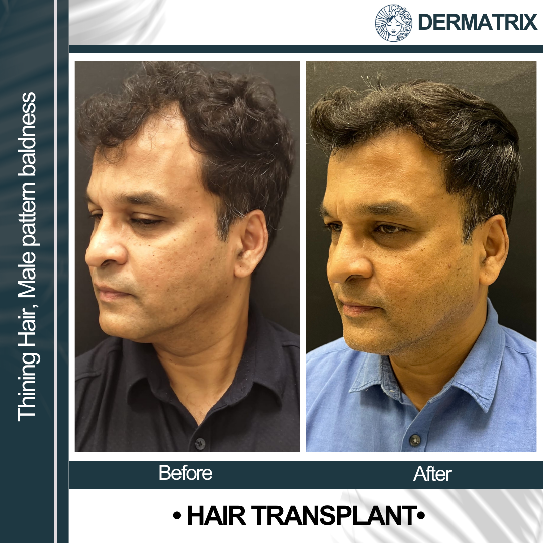 Hair_transplant_1